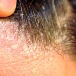 De ce rezultatele pentru dermatita seboreică apar și dispar „nu mai funcționează”